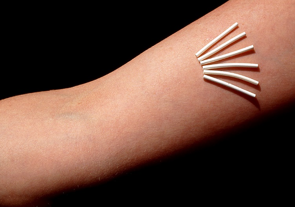 皮下埋植避孕法详细介绍 ⽪下埋植避孕法详细介绍