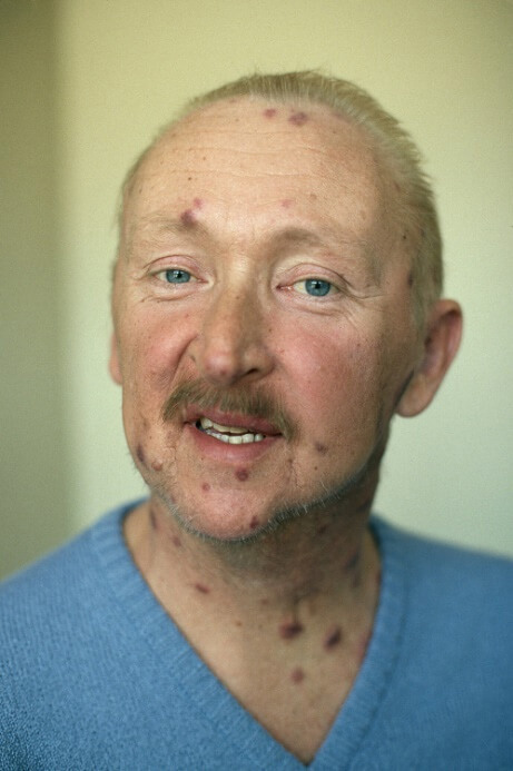 感染艾滋病病毒急性期有哪些症状? 感染艾滋病病毒急性期有哪些症状?